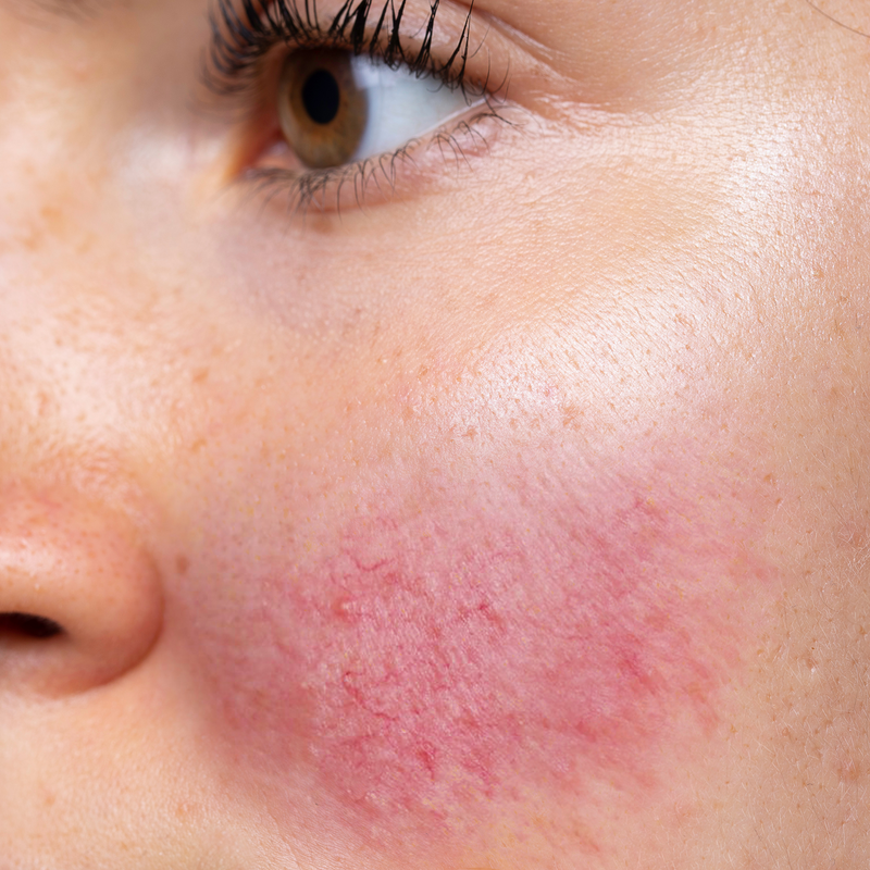 close up image of redness on woman's cheek