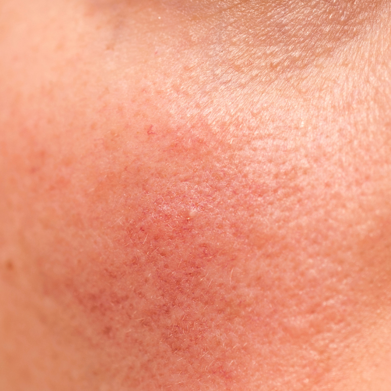 SENSITIVE SKIN